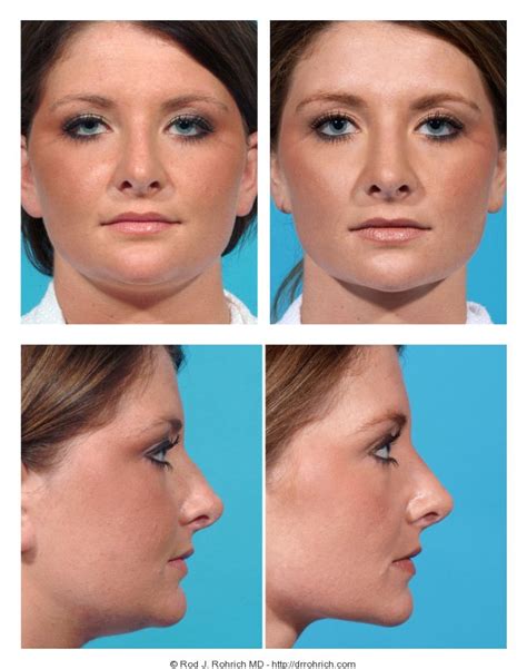 Revision Rhinoplasty Before And After Photos