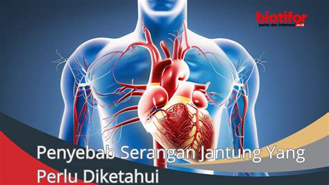 Penyebab Serangan Jantung Yang Perlu Diketahui