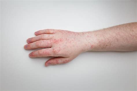 Patient Shows Arm And Hand With Red Itchy Painful Rash Allergic Symptom On Male Hands