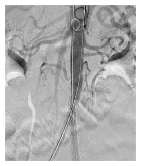 Reconstruction Of The Aortoiliac Occlusion With An Aortic Stent And