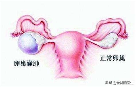 大多数卵巢癌发现已晚，医生建议：30岁以上女性每年一次妇科检查 每日头条