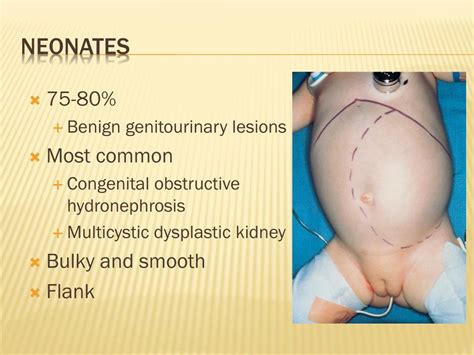 Ppt Neonatal Abdominal Masses Powerpoint Presentation Free Download