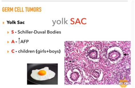 Ovarian Tumors Surface Epithelium Germ Cells Sex Cord Stroma Flashcards Quizlet