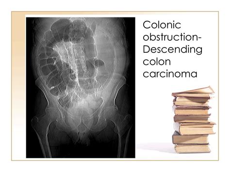 Ppt Bowel Obstruction Powerpoint Presentation Free Download Id 3378275