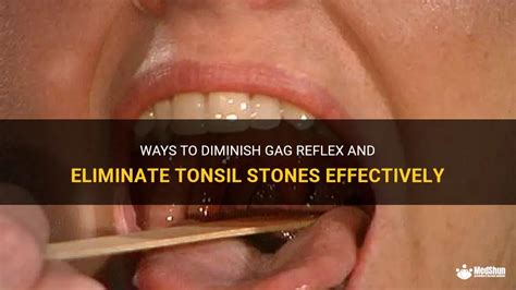 Ways To Diminish Gag Reflex And Eliminate Tonsil Stones Effectively Medshun