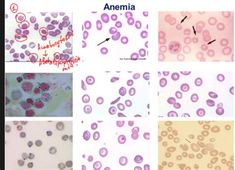 Biochemistry - Block 4 - Questions - Blood Smears - Hemoglobin - Sickle ...