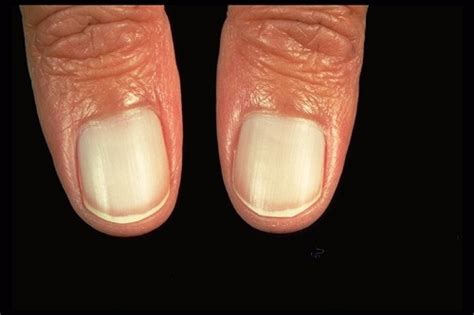 15 Disturbing Things Your Nails Reveal About Your Health Fallbrook247