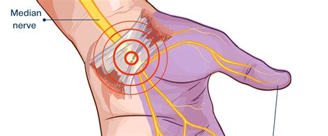Het Carpaal Tunnelsyndroom En Beeldschermwerk