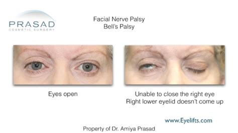 Eyelifts New York | Dr. Amiya Prasad | Facial Paralysis