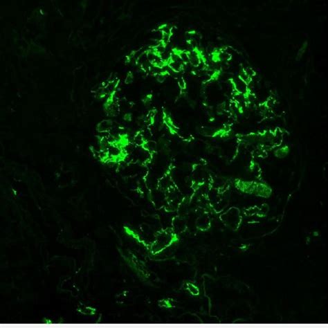 Glomerular Immunofluorescence Showing Diffuse Granular Mesangial