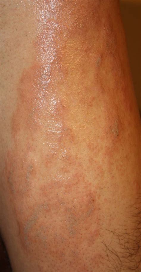 Autoimmune Rash » Reverse Autoimmune