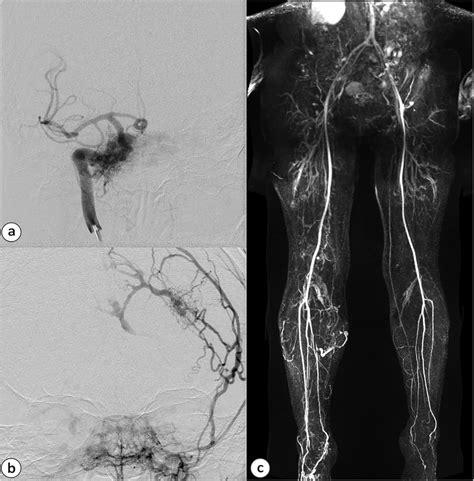 AP Digital Subtraction Angiography Evidenced Right Carotid Cavernous