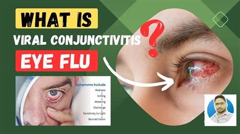 What Is Viral Conjunctivitis Eye Flu Symptoms And Precautions Youtube