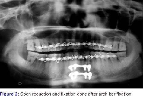 Figure 2 From Intermaxillary Fixation Screws Versus Erich Arch Bars In