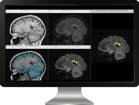 Ms Brain Mri With Contrast