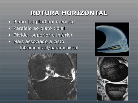 Meniscos Aspectos Radiológicos Das Rupturas E Outras Lesões