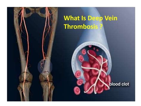 Dvt Prophylaxis In Orthopedic Surgeries Ppt