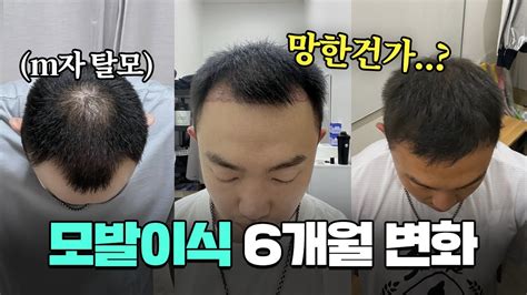 모발이식 암흑기를 거쳐 드디어 6달차 수술전부터 변화 과정 리뷰 비절개 3500모 Youtube