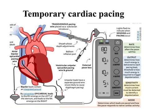 Temporary cardiac pacing