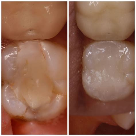 Tooth Colour Fillings Natural Looking Teeth Restoration