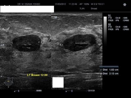 Fibroadenoma echocardiography or ultrasound - wikidoc