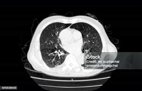 Ct Scan Tampilan Aksial Dada Untuk Diagnostik Emboli Paru Kanker