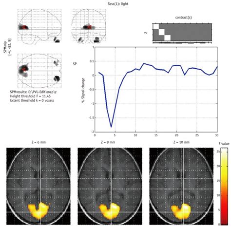 Active area and hemodynamic response function of normal... | Download ...