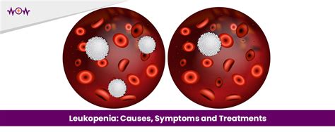 Leukopenia: Causes, Symptoms and Treatments - WoW Health Pakistan