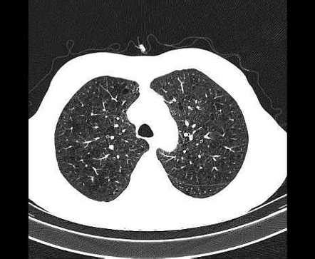 Emphysema Radiology