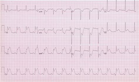 EKG Examples | Torrey EKG