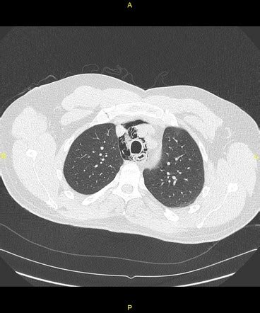 Esophageal Perforation And Its Treatment Radiology Case Radiopaedia Org