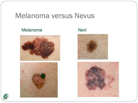 Ppt Machine Classification Of Melanoma And Nevi From Skin Lesions