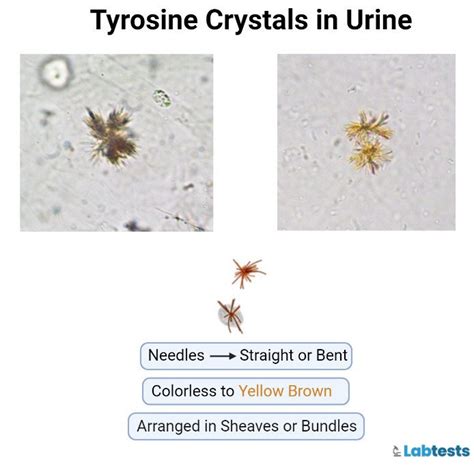 Urinary Crystals Types Causes And Clinical Significance