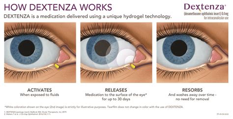 New Dextenza Reduces The Drop Regimen After Cataract Surgery Eye