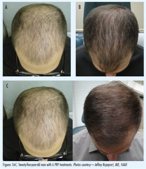 Incorporating Platelet Rich Plasma For Hair Restoration Into Your Practice