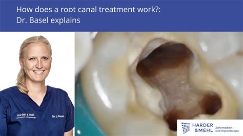 How Does A Root Canal Treatment Work Dr Basel Explains Youtube