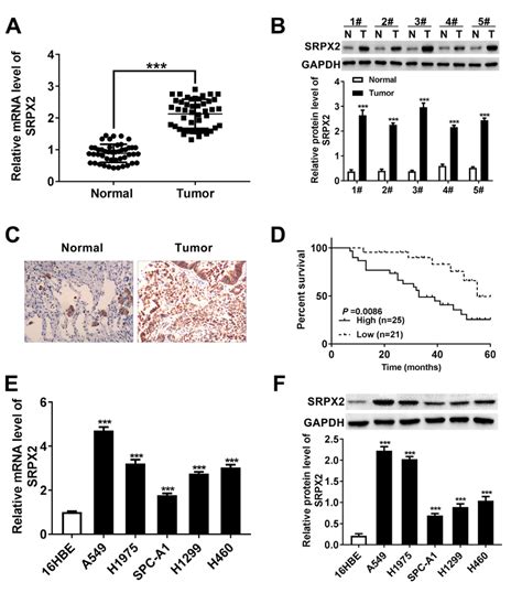 Srpx2 Is Upregulated In Nsclc Tissues And Associated With Poor Download Scientific Diagram