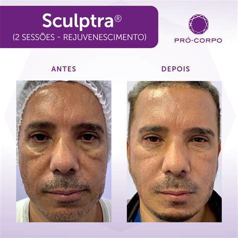 Fotos De Antes E Depois Resultados De Nossos Tratamentos Pr Corpo