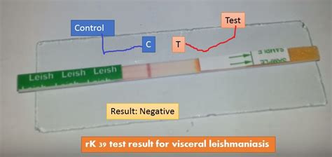 RK39 Test For Visceral Leishmaniasis Introduction Importance Principle