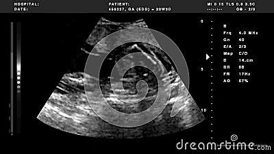 Ultrasound Black And White Version Stock Footage Video Of Pregnancy