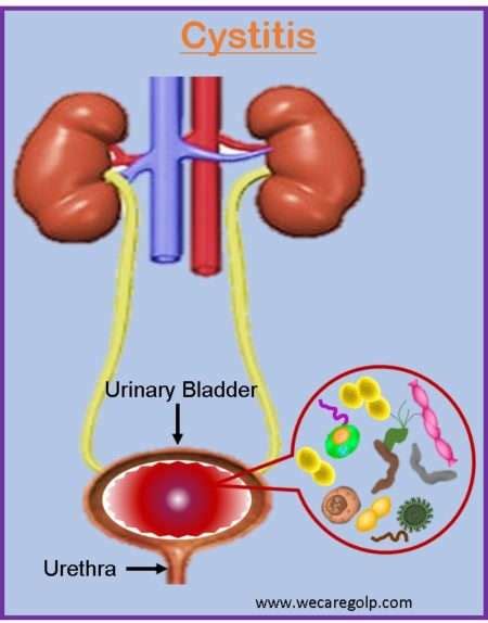 Cystitis: Classification, Management, Prevention - We Care