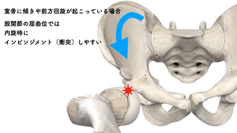 股関節の障害│アギトス鍼灸整骨院