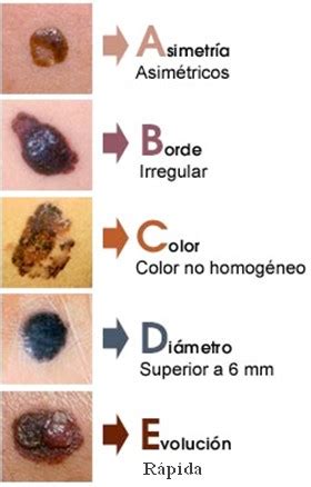 Diagnostico Precoz De Cancer De Piel Melanomas Cancer Cenderlaser