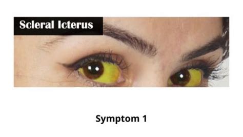 Scleral Icterus: List of Causes, Symptoms and Treatment