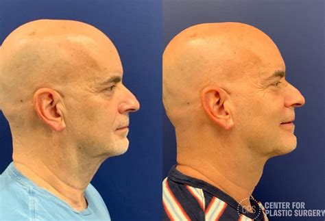 Necklift Before After Photos Of Patient At The Center For Plastic