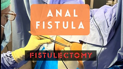 Anal Fistula Simple Fistulectomy YouTube