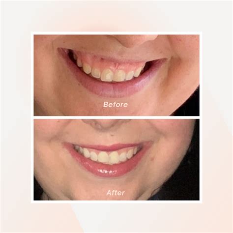 A Lip Flip Is A Nonsurgical Method Of Creating A Fuller Lip A Doctor