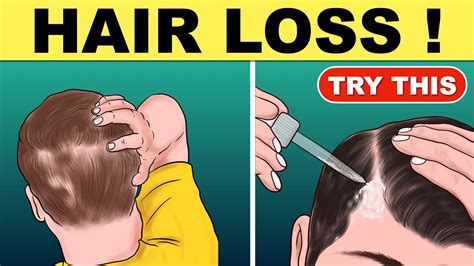 Hair Fall Treatment Home Remedies For Hair Fall Hair Fall Solution