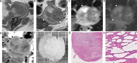 [pdf] Mr Imaging Findings Of Uterine Adenomatoid Tumors Semantic Scholar