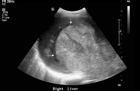 Large Hepatocellular Carcinoma on Ultrasound - radRounds Radiology Network